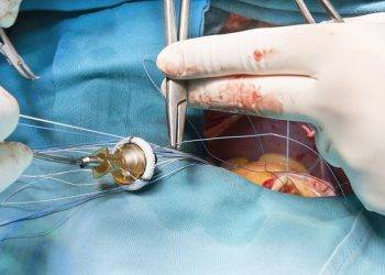 How Long Is AVR Surgery?